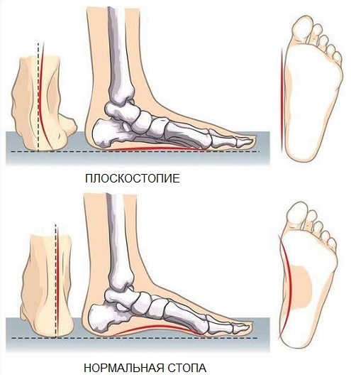 Как выбрать ортопедическую обувь
